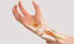 carpal tunnel syndrome 490 opt jan 25