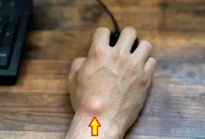 ganglion cyst deposit 485 opt jan 26