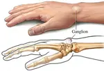 ganglion cyst wrist 403 opt feb 25