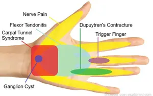 pain in palm of hand diagram 500 opt march 26