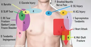 shoulder pain diagram 690 opt jan 22