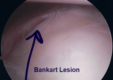 A Bankart Lesion seen during a shoulder arthroscopy bankart lesion 380 opt aug 23