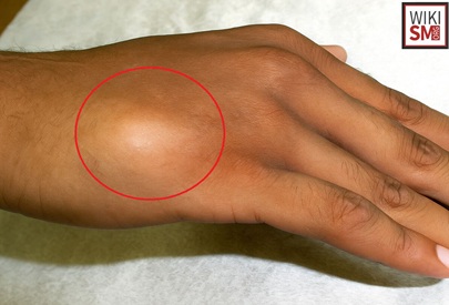 Boxer's Fracture Symptoms: Swelling and deformity from a break in the 5th metacarpal neck