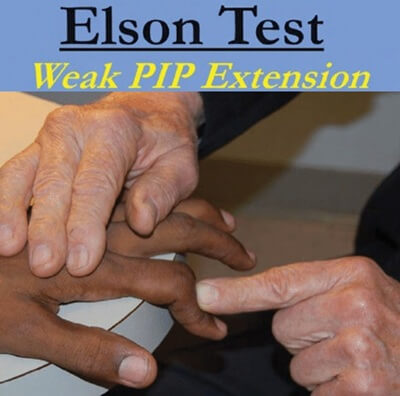 Elson Test for Boutonniere Deformity of the finger from central slip injury