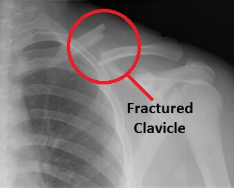 clavicle bone fracture