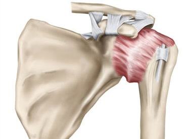 Frozen shoulder aka adhesive capsulitis causes stiffness and restricted shoulder movements and can also cause shoulder pain going down arm Frozen shoulder aka adhesive capsulitis causes stiffness and restricted shoulder movements and can also cause shoulder pain going down arm