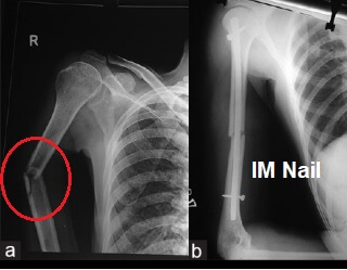 Intramedullary nailing of a midshaft humeral fracture