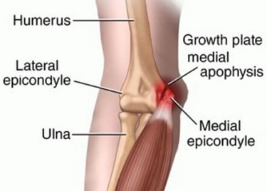 Medial Elbow Ligament Sprain - Symptoms, Causes, Treatment & Rehab