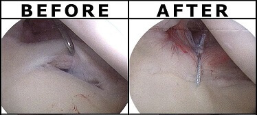Arthroscope images before and after SLAP tear surgery