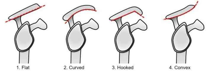 Acromion shape affects the size of the subacromial space. People with a hooked acromion are more likely to develop shoulder impingement syndrome Acromion shape affects the size of the subacromial space. People with a hooked acromion are more likely to develop shoulder impingement syndrome