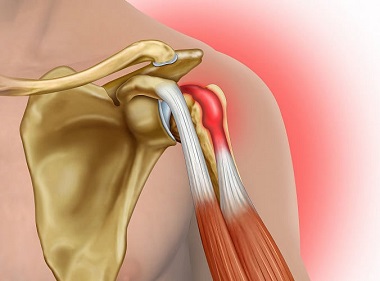 Biceps tendonitis is an overuse injury that causes upper arm pain either around the shoulder or elbow