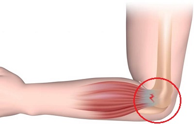 Back Of Elbow Pain: Tennis Elbow. Causes, symptoms, diagnosis and treatment for outer posterior elbow pain