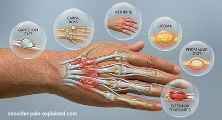 Back Of Hand Lump Chart: Common causes of lumps in the back of the hand and how to treat them