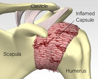 Why Upper Back Stiffness Could Be the Root Cause of Your Shoulder