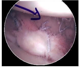 Surgical repair of a Bankart lesion Surgical repair of a Bankart lesion