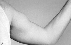Popeye Muscle from a biceps tendon tear