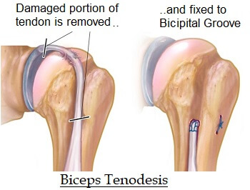 Biceps Tendonitis Causes Symptoms Treatment