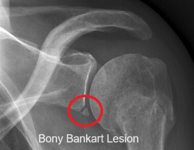 Bankart Lesion Causes Symptoms Treatment Bankart Lesion Causes Symptoms Treatment