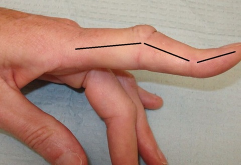 Boutonniere Deformity: Causes, symptoms, diagnosis and treatment of buttonhole finger from a central slip injury.