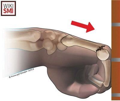 What Is A Boxer's Fracture? A break in the 5th metacarpal neck usually caused by punching something hard with a clenched fist.