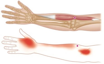 Brachioradialis Muscle Forearm Pain: Causes, symptoms, diagnosis & treatment