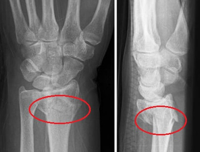 Broken Wrist Xray showing distal radius fracture