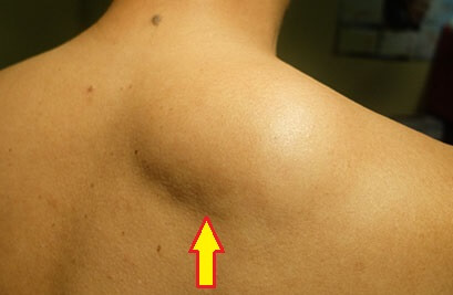 Bump On Back Of Shoulder: Lipoma. Common causes, symptoms, diagnosis and treatment of lipoma lumps on back of shoulder Bump On Back Of Shoulder: Lipoma. Common causes, symptoms, diagnosis and treatment of lipoma lumps on back of shoulder
