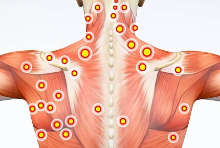 Myofascial Trigger Points can cause shoulder pain that radiates down the arm to the hand. Find out about the causes, symptoms and treatment options Myofascial Trigger Points can cause shoulder pain that radiates down the arm to the hand. Find out about the causes, symptoms and treatment options