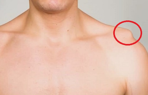 Lump Or Bump On Top Of Shoulder: Causes & Treatment