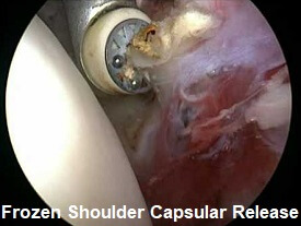 Capsular release frozen shoulder surgery for adhesive capsulitis Capsular release frozen shoulder surgery for adhesive capsulitis