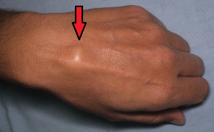 Carpal Boss Lump On Top Of Wrist: Causes, symptoms and treatment