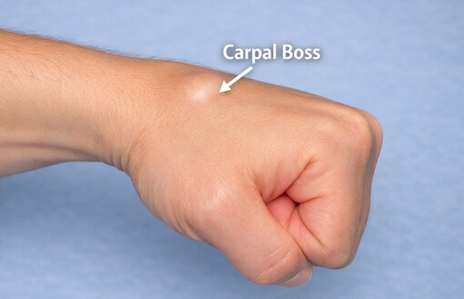 Carpal Boss Wrist Guide: Find out about the common causes, symptoms and treatment options for a hard lump on back of hand from a carpal boss Carpal Boss Wrist Guide: Find out about the common causes, symptoms and treatment options for a hard lump on back of hand from a carpal boss