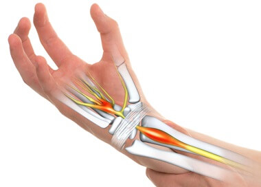 Carpal Tunnel Syndrome: Causes forearm and hand pain, tingling & numbness