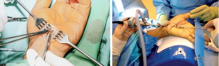 Carpal Tunnel Syndrome Surgery: Open CTS surgery and endoscopic CTS surgery