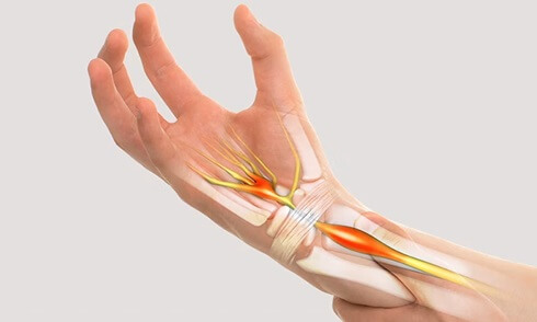 What Is Carpal Tunnel Syndrome? Causes, symptoms, diagnosis and treatment of Carpal Tunnel