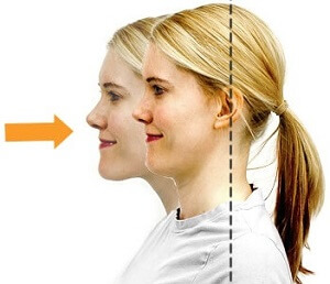 Chin Tuck Neck Retractions: Upper trapezius stretches Chin Tuck Neck Retractions: Upper trapezius stretches