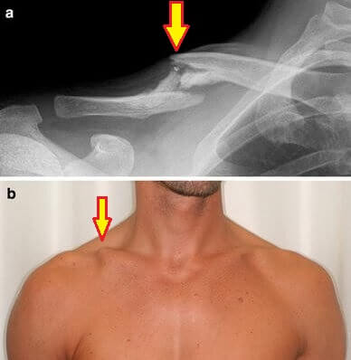 Lump On Clavicle from Collarbone Fracture