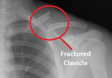 Common causes of pain on front of shoulder: clavicle fracture