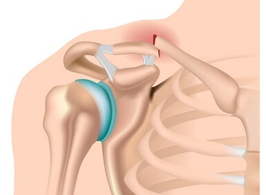 Clavicle Fracture: Causes, Symptoms, Diagnosis & Treatment Clavicle Fracture: Causes, Symptoms, Diagnosis & Treatment