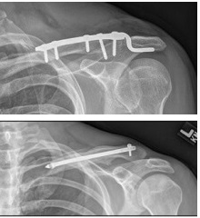 Plating of a clavicle fracture