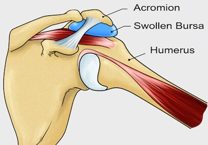 Any decrease in the subacromial space places increased pressure on the bursa which can lead to subacromial bursitis.  It is often accompanied by shoulder impingement.