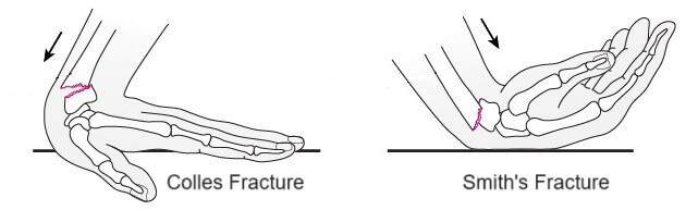 Colles vs Smith Fracture: Different mechanisms of injury, both from falls