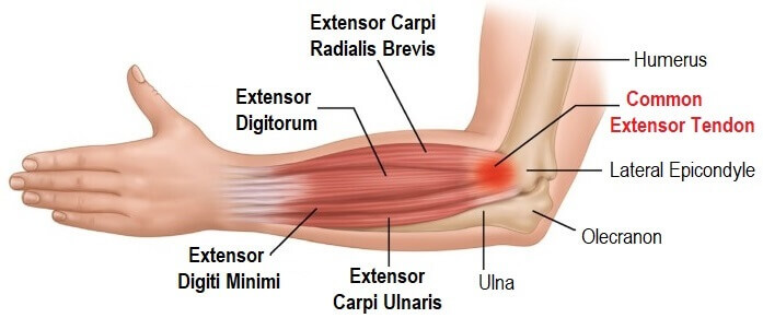 Tennis Elbow Anatomy: The common extensor tendon attaches to the lateral epicondyle on the outer elbow Tennis Elbow Anatomy: The common extensor tendon attaches to the lateral epicondyle on the outer elbow