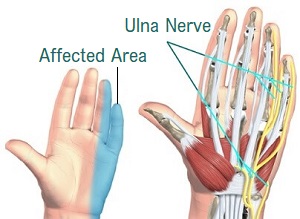 Ulnar Nerve Entrapment Cheshire  Cubital Tunnel Syndrome Stafford