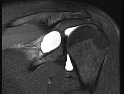 Cyst In Shoulder: MRI Scan showing shoulder cysts Cyst In Shoulder: MRI Scan showing shoulder cysts