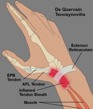 De Quervain Tenosynovitis: Inflammation of the Abductor Pollicis Longus (APL) and Extensor Pollicis Brevis (EPB) Tendon Sheath