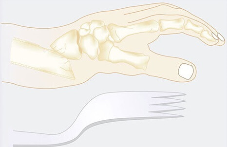 The dinner fork deformity is a classic presentation of Colles fractures at the wrist