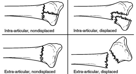 Different types of distal radial fracture: Displaced/non-displaced and intra-articular/extra-articular distal radius fractures