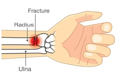 Distal Radius Fracture: Causes, Symptoms, Diagnosis & Treatment Options For Wrist Fractures