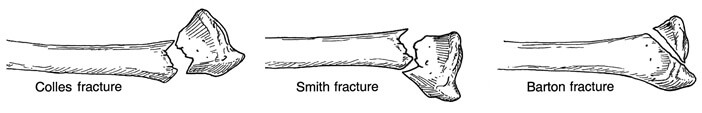 There are lots of different types of distal radius fracture including Colles Fractures, Smith Fractures and Barton Fracture There are lots of different types of distal radius fracture including Colles Fractures, Smith Fractures and Barton Fracture